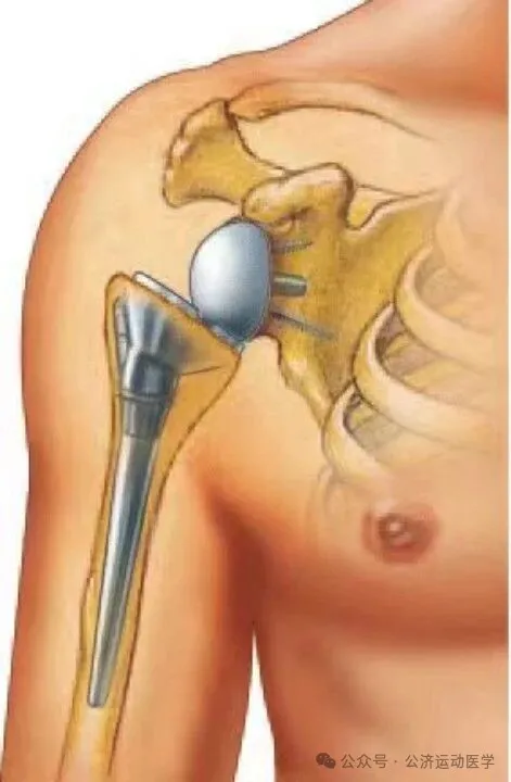 Diagram of reverse total shoulder arthroplasty